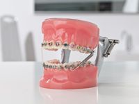 Feste Zahnspange mit Forsus-Apparatur