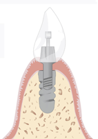 Darstellung eines Implantats